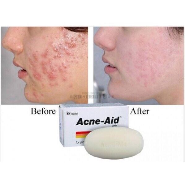 Acne Aid Acne Conrol Soap 100g - Image 2